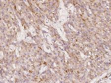 IGHMBP2 Antibody - Immunochemical staining of human IGHMBP2 in human hepatoma with rabbit polyclonal antibody at 1:300 dilution, formalin-fixed paraffin embedded sections.