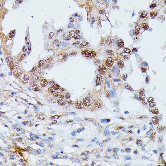 IGHMBP2 Antibody - Immunohistochemistry of paraffin-embedded Human lung cancer using IGHMBP2 Polyclonal Antibody at dilution of 1:100 (40x lens).