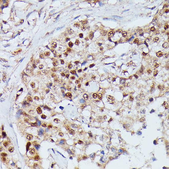 IGHMBP2 Antibody - Immunohistochemistry of paraffin-embedded Human mammary cancer using IGHMBP2 Polyclonal Antibody at dilution of 1:100 (40x lens).