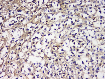IGLL1 / CD179b Antibody - IHC staining of FFPE human lymphocytic tumor with IGLL1 antibody at 1ug/ml. HIER: boil tissue sections in pH6, 10mM citrate buffer, for 10-20 min and allow to cool before testing.