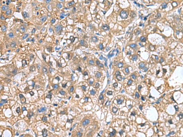 IGLL1 / CD179b Antibody - Immunohistochemistry of paraffin-embedded Human liver cancer tissue  using IGLL1 Polyclonal Antibody at dilution of 1:65(×200)
