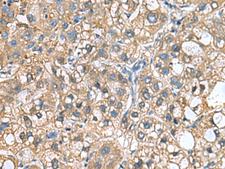 IGLL1 / CD179b Antibody - Immunohistochemistry of paraffin-embedded Human liver cancer tissue  using IGLL1 Polyclonal Antibody at dilution of 1:65(×200)