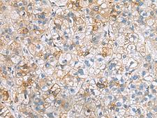 IGLL1 / CD179b Antibody - Immunohistochemistry of paraffin-embedded Human liver cancer tissue  using IGLL1 Polyclonal Antibody at dilution of 1:50(×200)