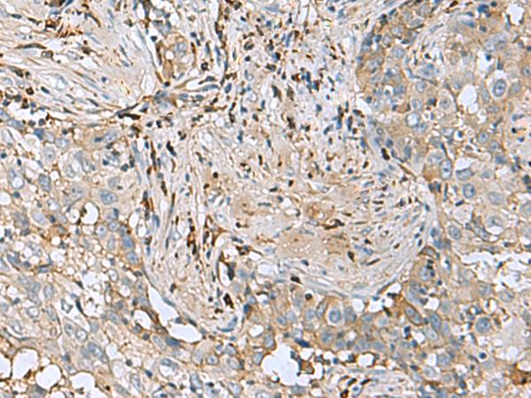IGLL1 / CD179b Antibody - Immunohistochemistry of paraffin-embedded Human esophagus cancer tissue  using IGLL1 Polyclonal Antibody at dilution of 1:50(×200)