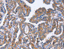 IGSF10 Antibody - Immunohistochemistry of paraffin-embedded Human liver cancer using IGSF10 Polyclonal Antibody at dilution of 1:50.