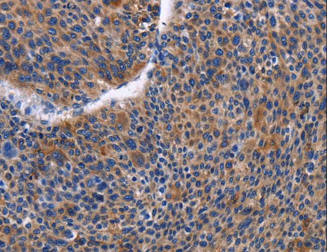 IGSF10 Antibody - Immunohistochemistry of paraffin-embedded Human liver cancer using IGSF10 Polyclonal Antibody at dilution of 1:50.