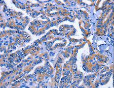 IGSF10 Antibody - Immunohistochemistry of paraffin-embedded Human thyroid cancer using IGSF10 Polyclonal Antibody at dilution of 1:60.