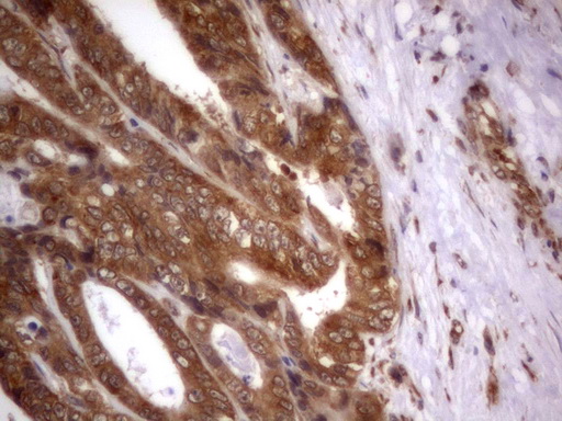 IGSF11 / VSIG3 Antibody - IHC of paraffin-embedded Adenocarcinoma of Human colon tissue using anti-IGSF11 mouse monoclonal antibody. (Heat-induced epitope retrieval by 1 mM EDTA in 10mM Tris, pH8.5, 120°C for 3min).