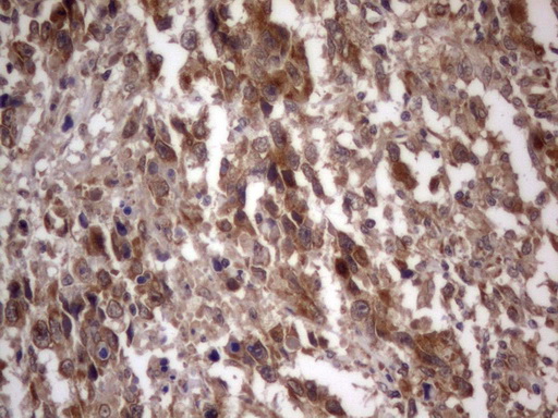IGSF11 / VSIG3 Antibody - IHC of paraffin-embedded Adenocarcinoma of Human ovary tissue using anti-IGSF11 mouse monoclonal antibody. (Heat-induced epitope retrieval by 1 mM EDTA in 10mM Tris, pH8.5, 120°C for 3min).