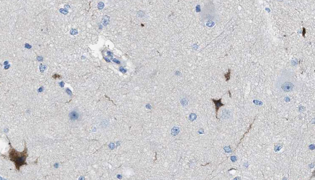 IGSF4C / CADM4 Antibody - 1:100 staining human brain carcinoma tissue by IHC-P. The sample was formaldehyde fixed and a heat mediated antigen retrieval step in citrate buffer was performed. The sample was then blocked and incubated with the antibody for 1.5 hours at 22°C. An HRP conjugated goat anti-rabbit antibody was used as the secondary.