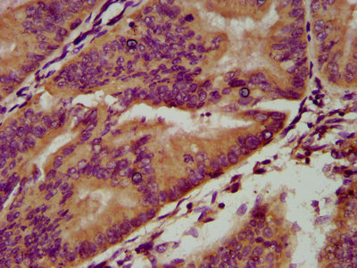 IGSF9 Antibody - Immunohistochemistry image at a dilution of 1:200 and staining in paraffin-embedded human endometrial cancer performed on a Leica BondTM system. After dewaxing and hydration, antigen retrieval was mediated by high pressure in a citrate buffer (pH 6.0) . Section was blocked with 10% normal goat serum 30min at RT. Then primary antibody (1% BSA) was incubated at 4 °C overnight. The primary is detected by a biotinylated secondary antibody and visualized using an HRP conjugated SP system.
