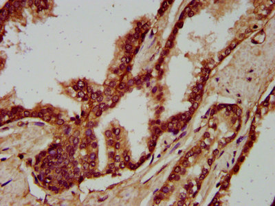IGSF9 Antibody - Immunohistochemistry image at a dilution of 1:200 and staining in paraffin-embedded human prostate cancer performed on a Leica BondTM system. After dewaxing and hydration, antigen retrieval was mediated by high pressure in a citrate buffer (pH 6.0) . Section was blocked with 10% normal goat serum 30min at RT. Then primary antibody (1% BSA) was incubated at 4 °C overnight. The primary is detected by a biotinylated secondary antibody and visualized using an HRP conjugated SP system.