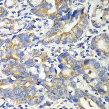 ABAT Antibody - Immunohistochemistry of paraffin-embedded human gastric cancer tissue.