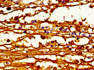 ABCB4 / MDR3 Antibody - Immunohistochemistry image of paraffin-embedded human melanoma cancer at a dilution of 1:100