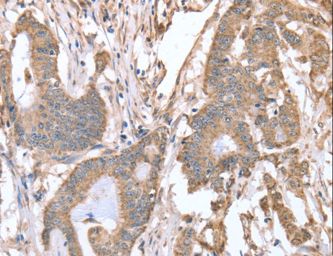 ABCB6 Antibody - Immunohistochemistry of paraffin-embedded Human colon cancer using ABCB6 Polyclonal Antibody at dilution of 1:15.