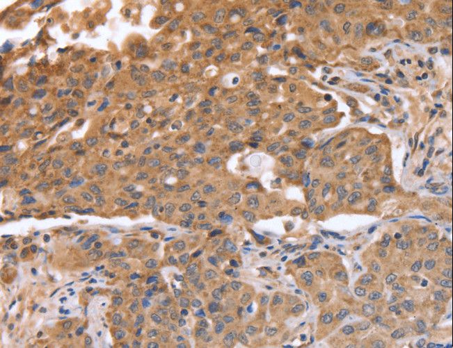 ABCB6 Antibody - Immunohistochemistry of paraffin-embedded Human lung cancer using ABCB6 Polyclonal Antibody at dilution of 1:15.