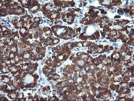 ACAA2 Antibody - IHC of paraffin-embedded Carcinoma of Human thyroid tissue using anti-ACAA2 mouse monoclonal antibody, at a dilution of 1:150.