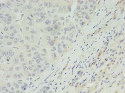 ACADL Antibody - Immunohistochemistry of paraffin-embedded human liver cancer using antibody at dilution of 1:100.