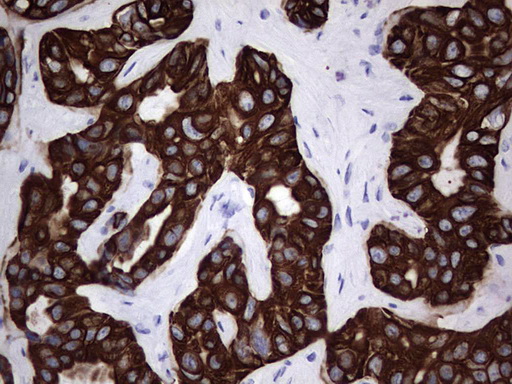 Acidic Cytokeratin Antibody - IHC of paraffin-embedded Carcinoma of Human liver tissue using anti-Acidic CK rat monoclonal antibody.