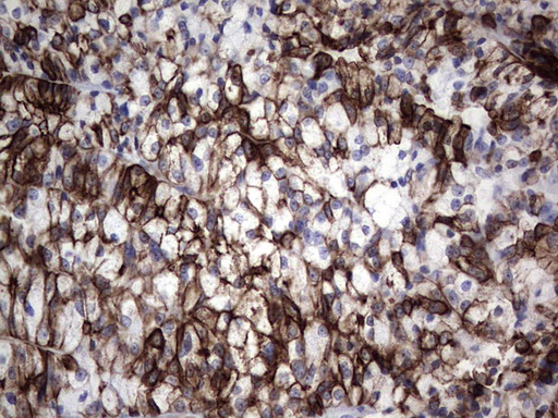 Acidic Cytokeratin Antibody - IHC of paraffin-embedded Carcinoma of Human thyroid tissue using anti-Acidic CK rat monoclonal antibody.