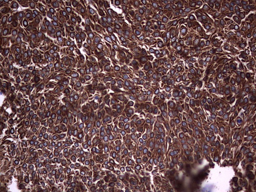 Acidic Cytokeratin Antibody - IHC of paraffin-embedded Carcinoma of Human bladder tissue using anti-Acidic CK rat monoclonal antibody.