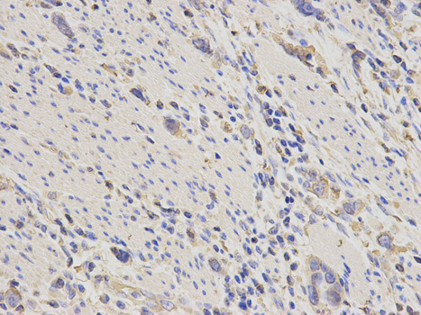 ACTN1 Antibody - Immunohistochemistry of paraffin-embedded human stomach cancer using ACTN1 antibody at dilution of 1:200 (400x lens).