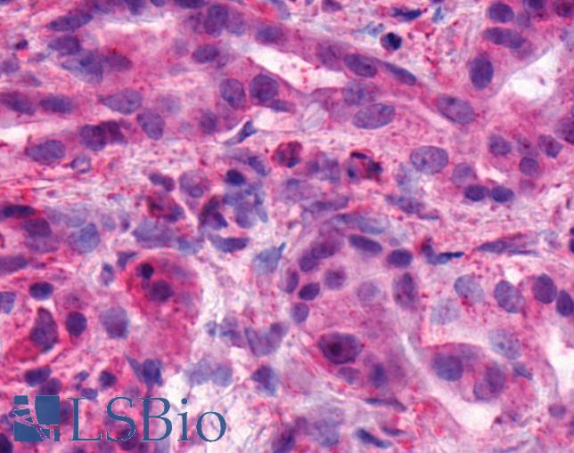 ADGRB1 / BAI1 Antibody - Anti-BAI1 antibody IHC of human Pancreas, Carcinoma. Immunohistochemistry of formalin-fixed, paraffin-embedded tissue after heat-induced antigen retrieval.