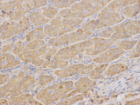 AMBP  Antibody - Immunohistochemistry of paraffin-embedded human liver cancer using AMBP antibody at dilution of 1:100 (200x lens).