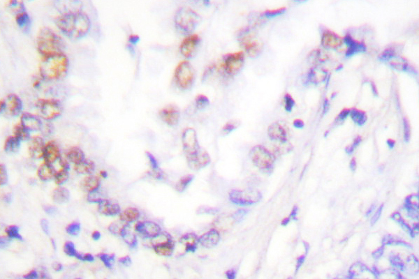 AML1 / RUNX1 Antibody - IHC of AML1 (H297) pAb in paraffin-embedded human lung carcinoma tissue.