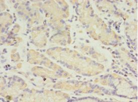 ANGPTL2 / ARP2 Antibody - Immunohistochemistry of paraffin-embedded human gastric cancer using antibody at 1:100 dilution.