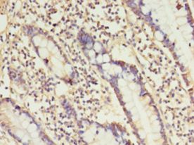 ANGPTL2 / ARP2 Antibody - Immunohistochemistry of paraffin-embedded human small intestine cancer using antibody at 1:100 dilution.