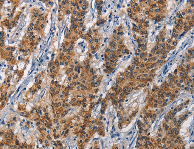 APOL1 / Apolipoprotein L Antibody - Immunohistochemistry of paraffin-embedded Human gastric cancer using APOL1 Polyclonal Antibody at dilution of 1:40.