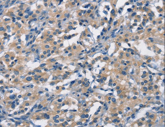 APOL1 / Apolipoprotein L Antibody - Immunohistochemistry of paraffin-embedded Human thyroid cancer using APOL1 Polyclonal Antibody at dilution of 1:40.