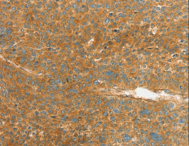 APOL2 / Apolipoprotein L 2 Antibody - Immunohistochemistry of paraffin-embedded Human liver cancer using APOL2 Polyclonal Antibody at dilution of 1:80.