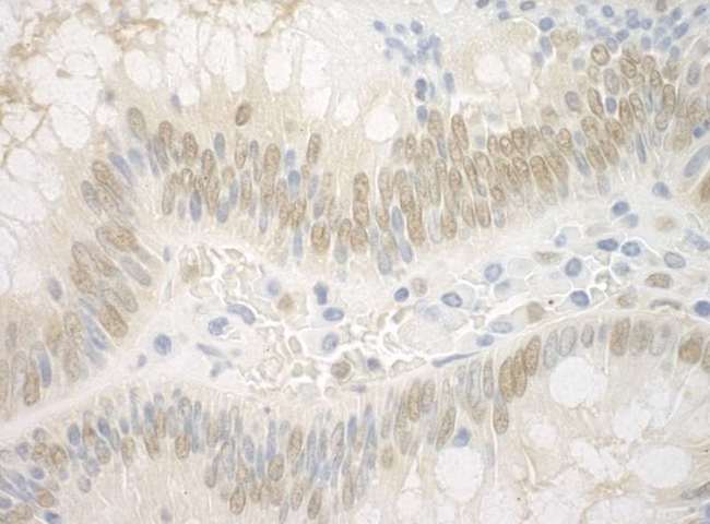 ARNT / HIF-1-Beta Antibody - Detection of Human ARNT by Immunohistochemistry. Sample: FFPE section of human colon carcinoma. Antibody: Affinity purified rabbit anti-ARNT used at a dilution of 1:5000 (0.2 Detection: DAB.