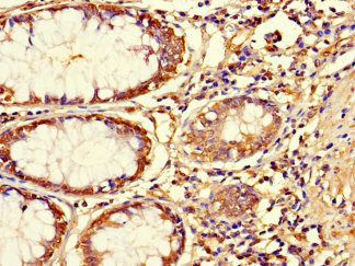 ASPN / Asporin Antibody - Immunohistochemistry of paraffin-embedded human colon cancer at dilution 1:100