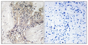 B3GALTL Antibody - IHC of paraffin-embedded human liver carcinoma tissue, using B3GALTL Antibody. The picture on the right is treated with the synthesized peptide.