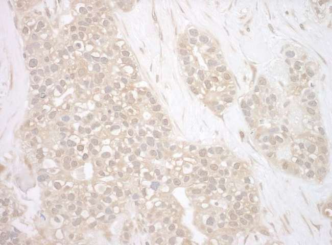 BAG3 / BAG-3 Antibody - Detection of Human BAG3 by Immunohistochemistry. Sample: FFPE section of human breast carcinoma. Antibody: Affinity purified rabbit anti-BAG3 used at a dilution of 1:200 (1 ug/mg).