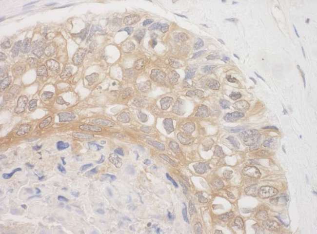 BAG3 / BAG-3 Antibody - Detection of Human BAG3 by Immunohistochemistry. Sample: FFPE section of human lung carcinoma. Antibody: Affinity purified rabbit anti-BAG3 used at a dilution of 1:500 (0.4 ug/mg).