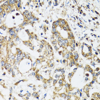 Band 4.1 / EPB41 Antibody - Immunohistochemistry of paraffin-embedded human colon carcinoma tissue.