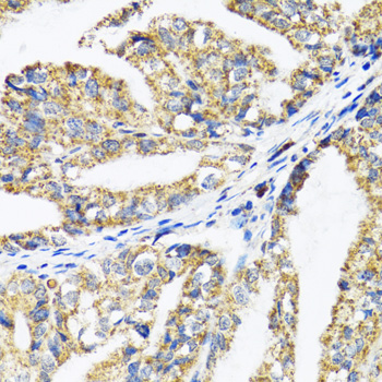 Band 4.1 / EPB41 Antibody - Immunohistochemistry of paraffin-embedded human gastric cancer tissue.