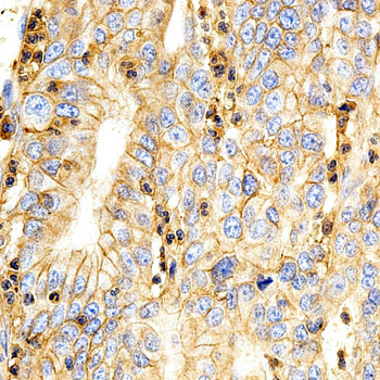 Basigin / Emmprin / CD147 Antibody - Immunohistochemistry of paraffin-embedded human stomach cancer tissue.