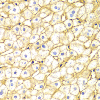 Basigin / Emmprin / CD147 Antibody - Immunohistochemistry of paraffin-embedded Human liver injury tissue.
