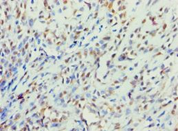 BBS4 Antibody - Immunohistochemistry of paraffin-embedded human breast cancer using antibody at 1:100 dilution.