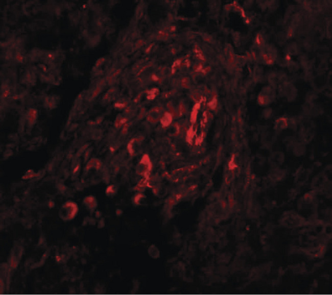 BCAS4 Antibody - Immunofluorescence of BCAS4 in human breast carcinoma tissue with BCAS4 antibody at 20 ug/ml.