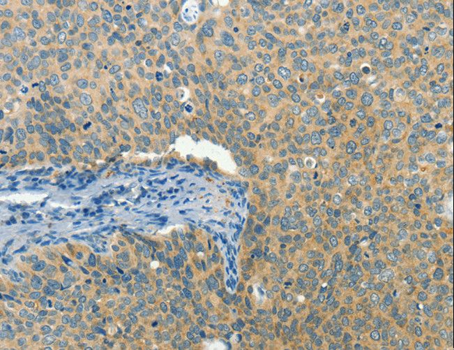 BCAT1 / ECA39 Antibody - Immunohistochemistry of paraffin-embedded Human cervical cancer using BCAT1 Polyclonal Antibody at dilution of 1:50.