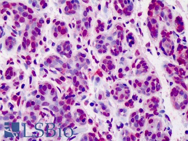 BCL2 / Bcl-2 Antibody - Anti-BCL2 / Bcl-2 antibody IHC of human breast. Immunohistochemistry of formalin-fixed, paraffin-embedded tissue after heat-induced antigen retrieval. Antibody dilution 1:50. This image was taken for the unconjugated form of this product. Other forms have not been tested.