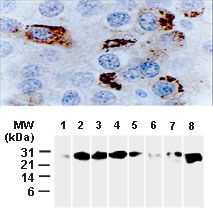 BCL2L1 / BCL-XL Antibody - Analysis of Bcl-X in human breast carcinoma using Polyclonal Antibody to Bcl-XL+S at 1:2000. A. Formalin-fixed, paraffin-embedded tissue section from invasive ductal carcinoma. An organellar/mitochondrial pattern of Bcl-X staining is observed in the cytosol of tumor cells. B. Western blot of tissue lysates from breast surgical tumor tissue biopsies (Lanes 1-7). Bcl-XS is not detected and variable amounts of Bcl-XL (~30 kD) is is detected. Lane 8. Recombinant Bcl-XL (positive control).
