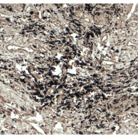 BECN2 Antibody - Immunohistochemistry of Beclin 2 in human lung carcinoma tissue with Beclin 2 antibody at 5 µg/ml.