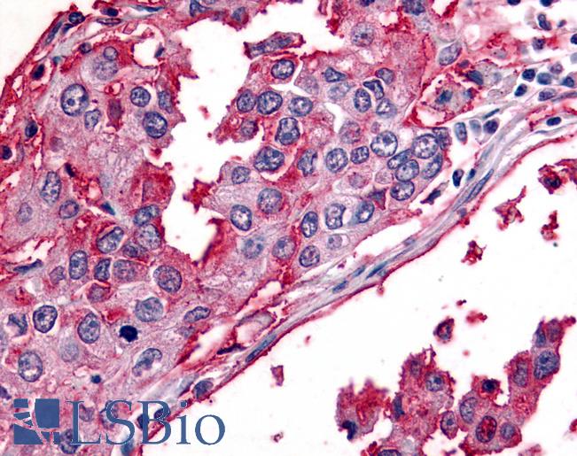 BEST2 / Bestrophin-2 Antibody - Anti-BEST2 / Bestrophin-2 antibody IHC of human Lung, Non-Small Cell Carcinoma. Immunohistochemistry of formalin-fixed, paraffin-embedded tissue after heat-induced antigen retrieval.